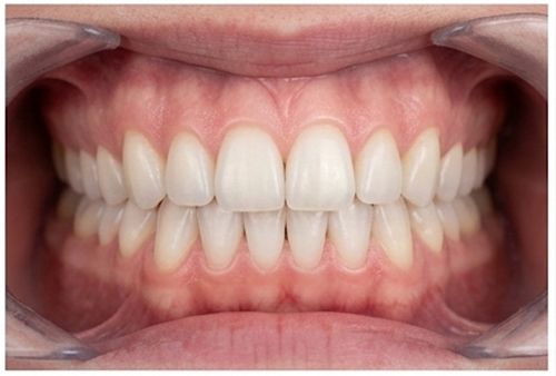 Front view — teeth together